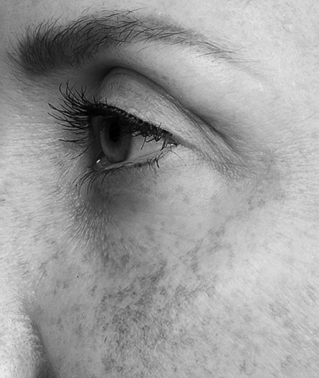 HYPERPIGMENTATION
