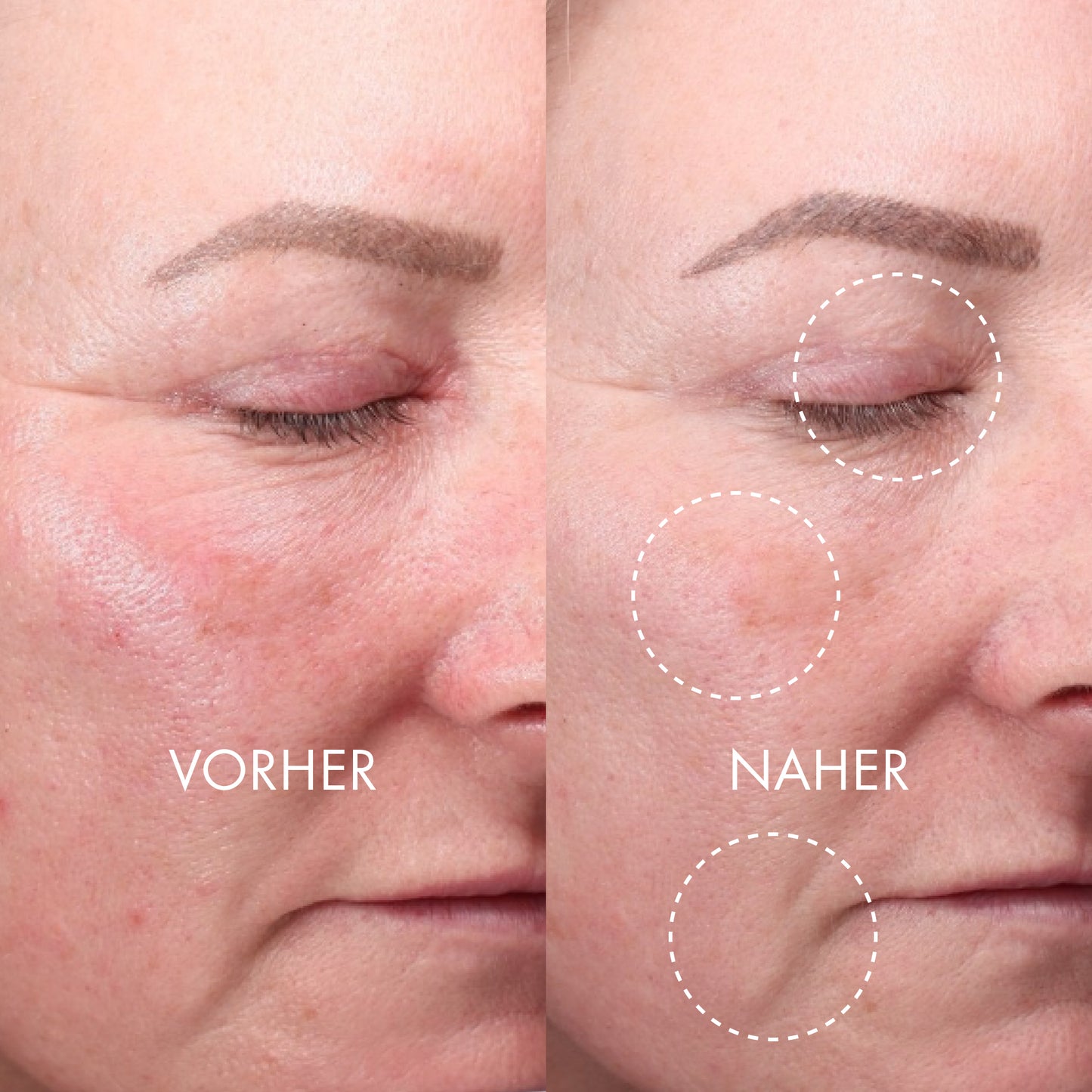DERMA EXPERT LED Light Treatment - QMS Medicosmetics UK