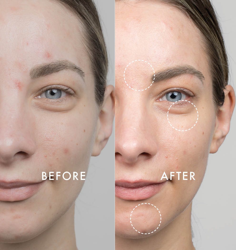 Side-by-side before and after comparison of a woman's face showing reduced blemishes, smoother skin texture, and improved clarity after skincare treatment.