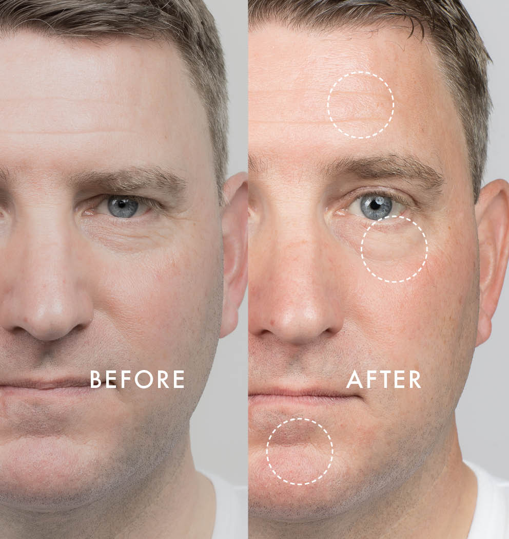 Side-by-side before and after comparison of a man's face showing reduced fine lines, smoother skin, and improved texture after skincare treatment.